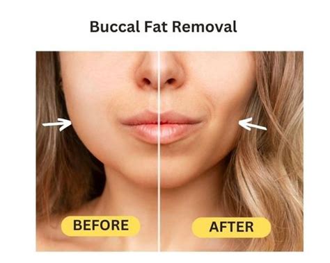 buccal fat removal pris|Buccal Fat Removal: The Pros, Cons, And What You Need To Know.